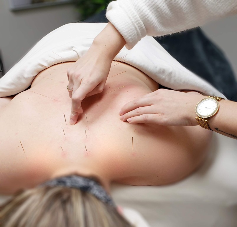 How Can You Use Acupuncture for Back Pain Treatment?