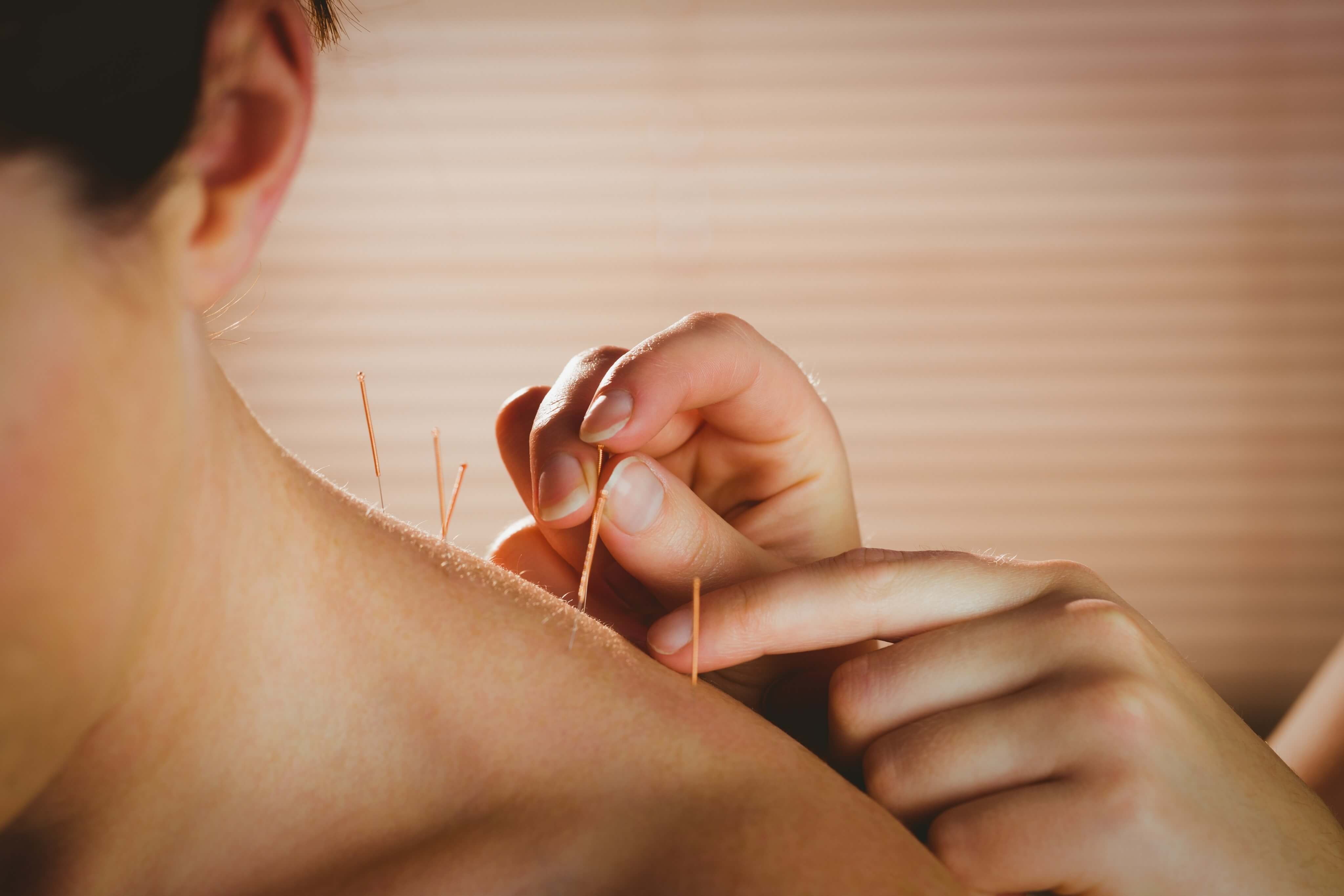 acupuncture treatment for pain relief