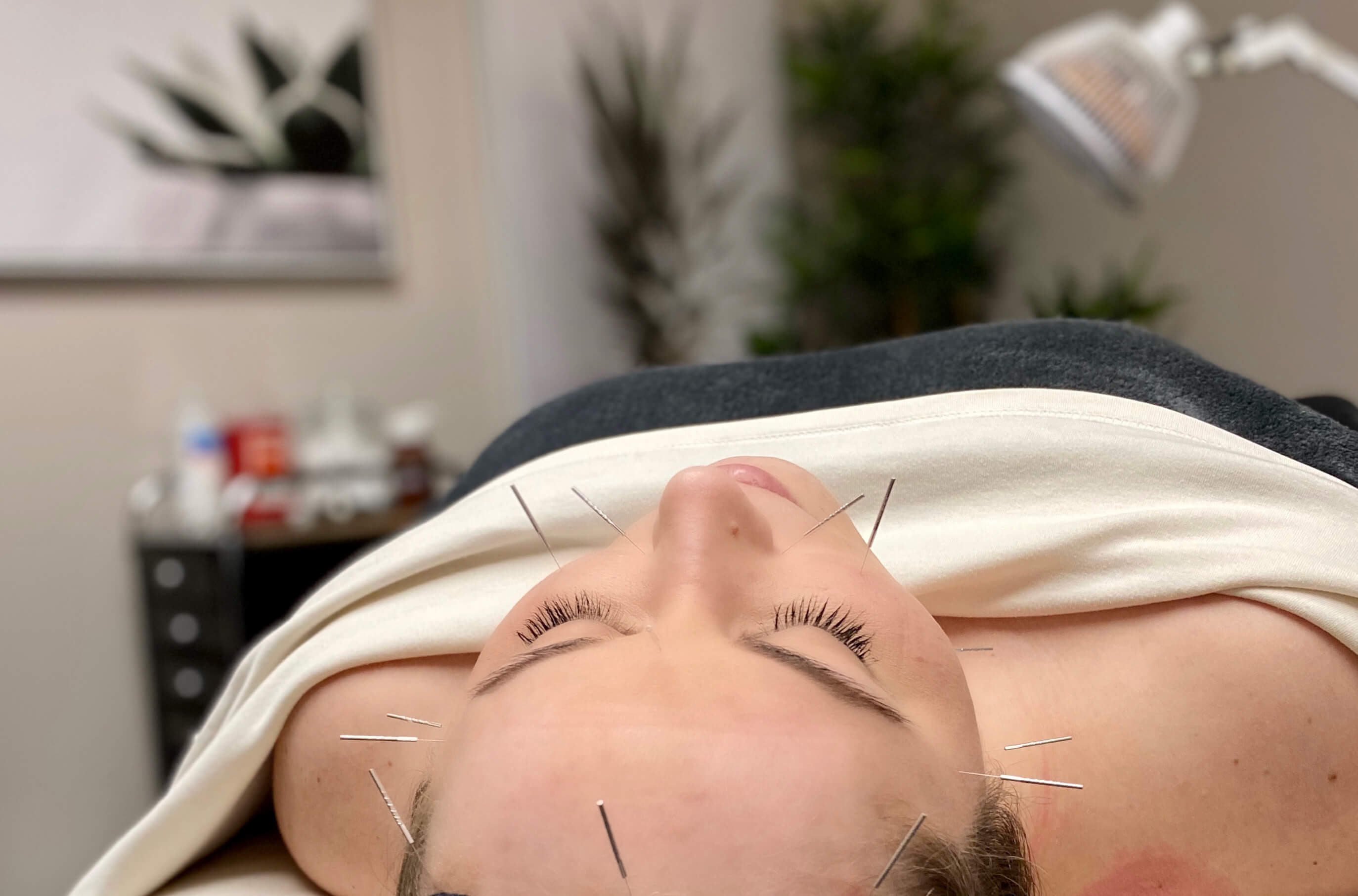 acupuncture treatment