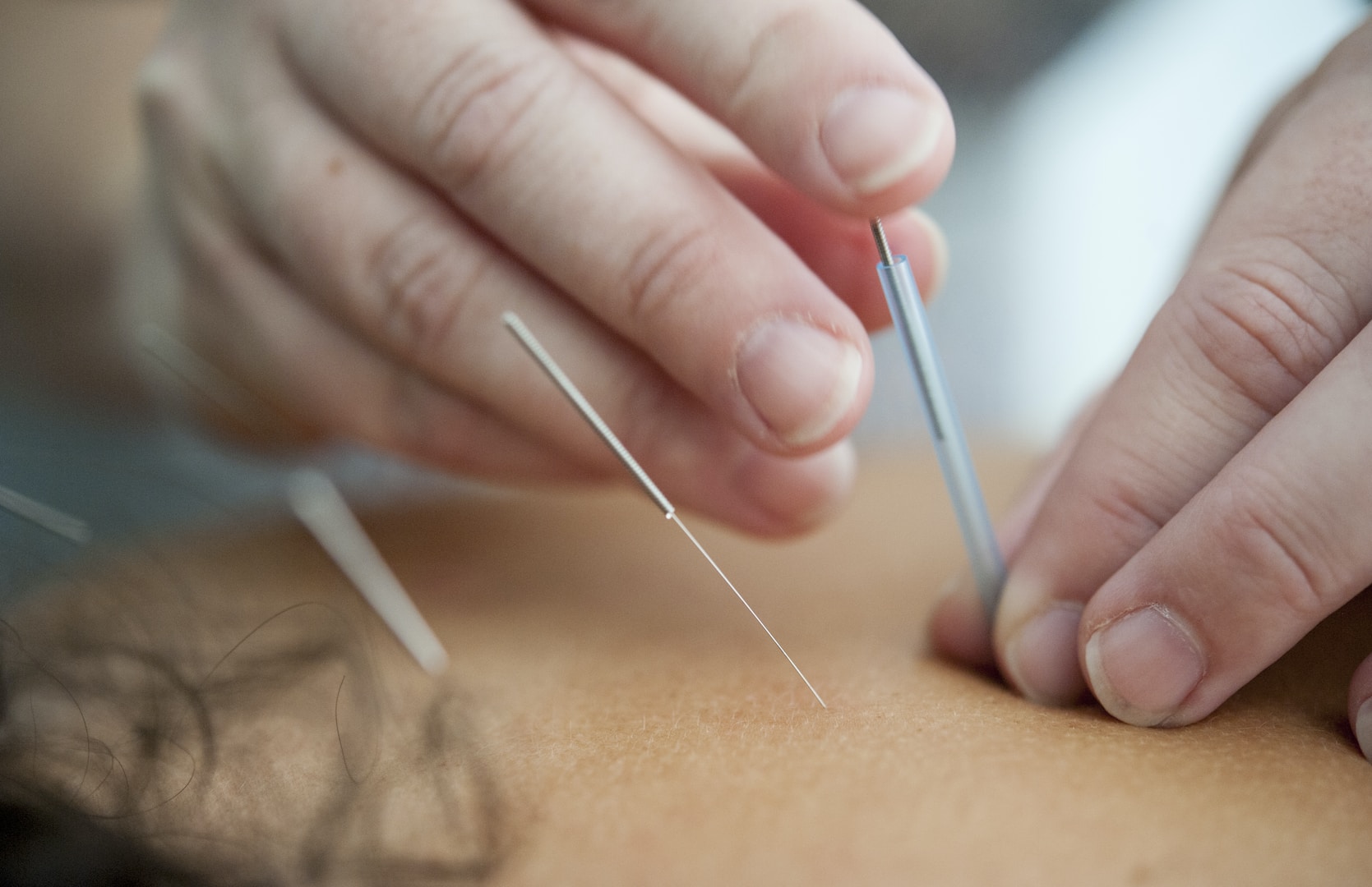 acupuncture holistic healing